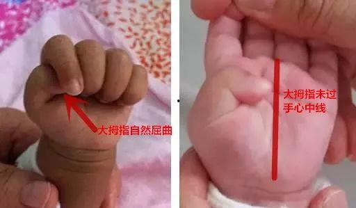 婴儿不正常握拳的图片